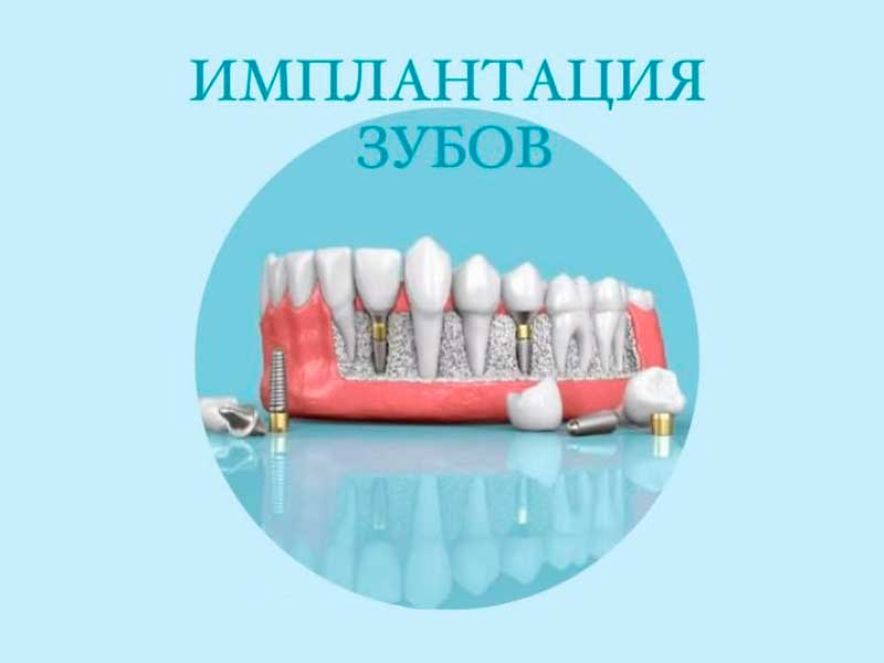 Имплантация зубов со скидкой