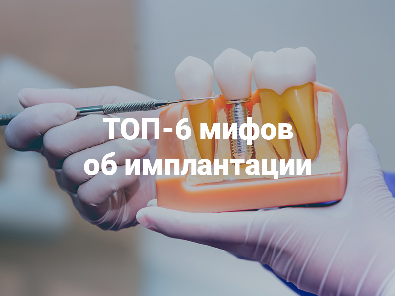 Топ 6 мифов про имплантацию зубов, в которые не стоит верить!