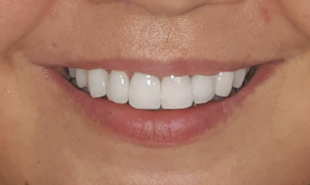 Image after